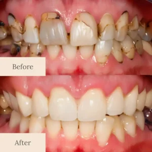 🔥First 100 :2nd ltem 50% Off🔥QIAWI® Teeth Armor Drops